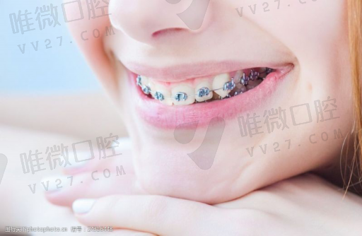 科普，做窝沟封闭的优点及其害处(图1)